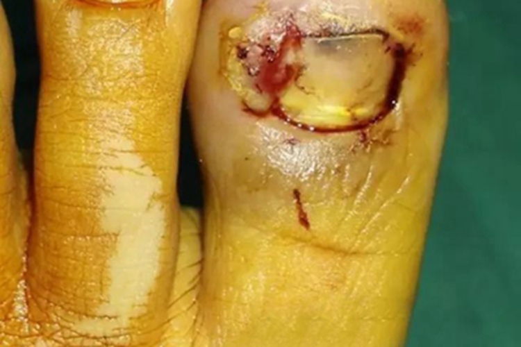 化脓性甲沟炎脚趾肿图 化脓性甲沟炎脚趾肿图