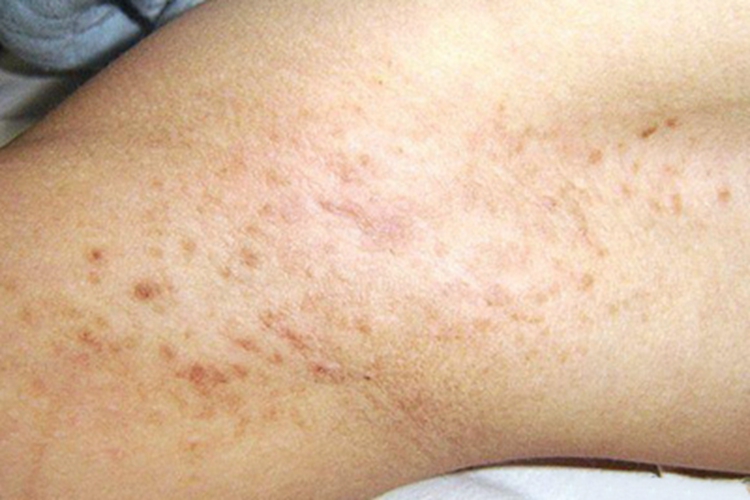 持久性豆状角化过度病腘窝症状图 持久性豆状角化过度病腘窝症状图