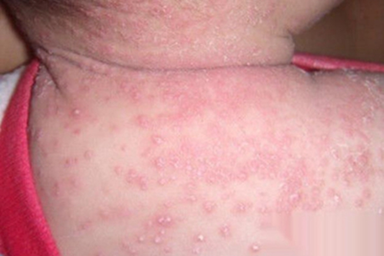 急性湿疹颈部症状图