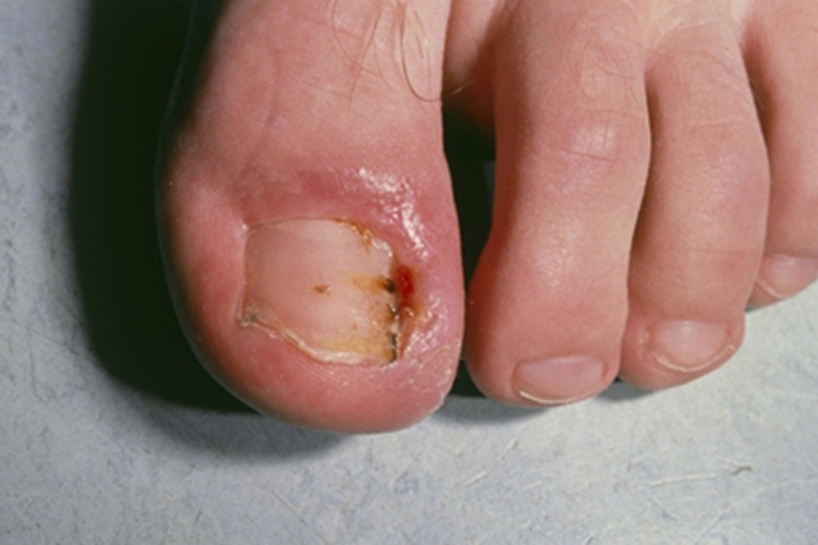 念珠菌性甲沟炎甲周症状图