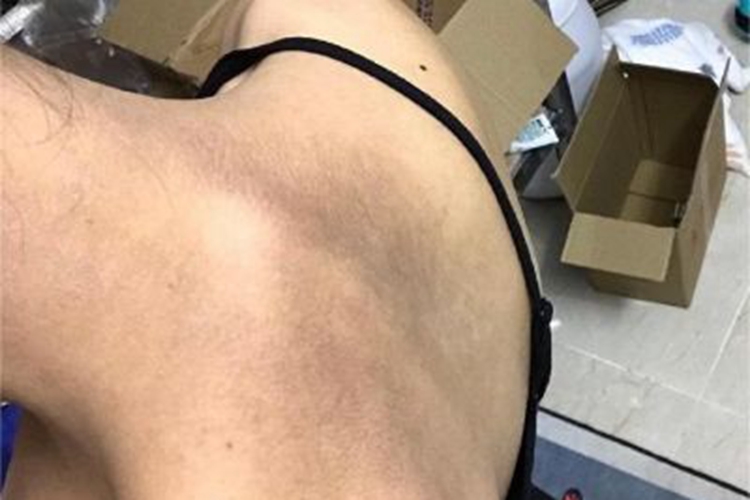 假性黑棘皮病背部皮肤粗糙图