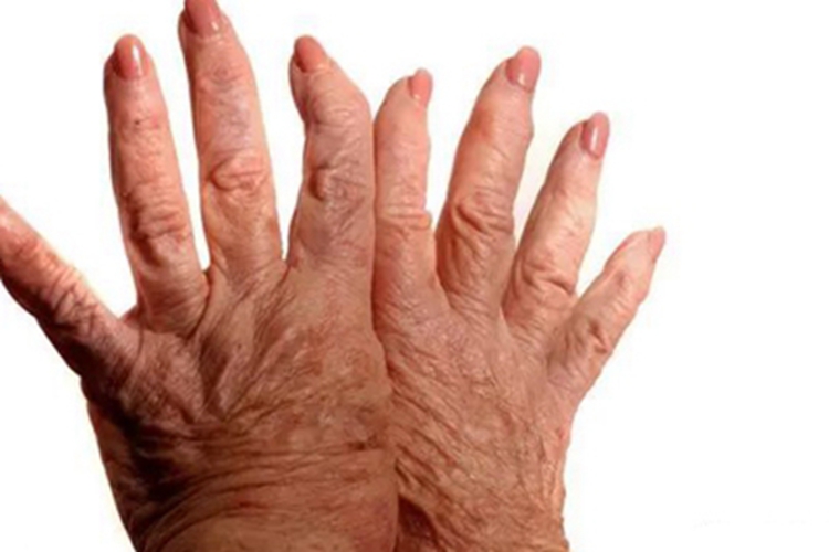 系统性硬皮病手指畸形图 系统性硬皮病手指畸形图