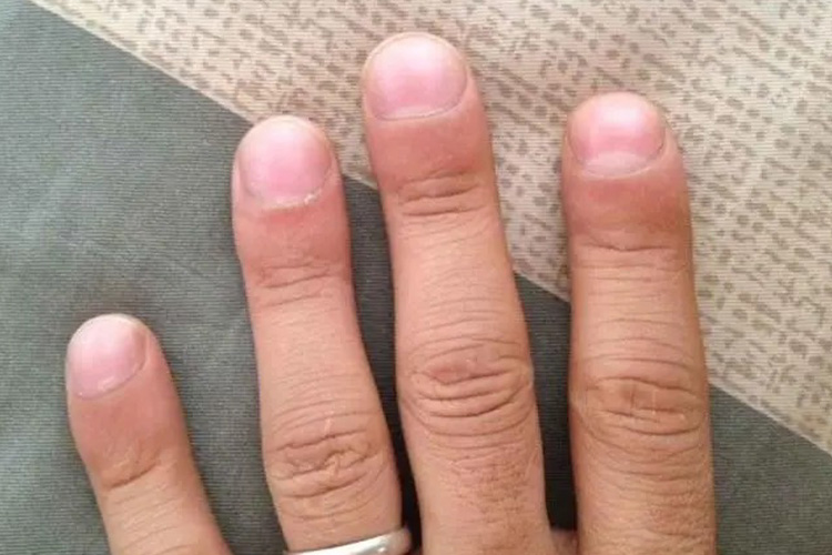 得了肺癌手指的照片图片