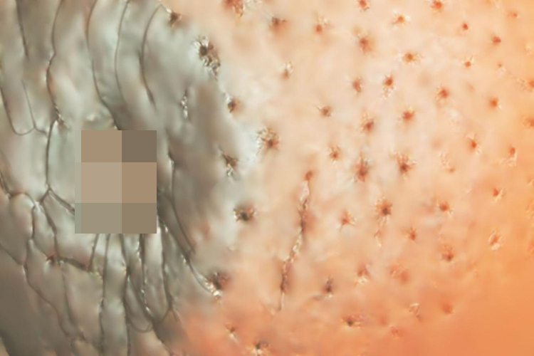 乳腺癌晚期橘皮征图