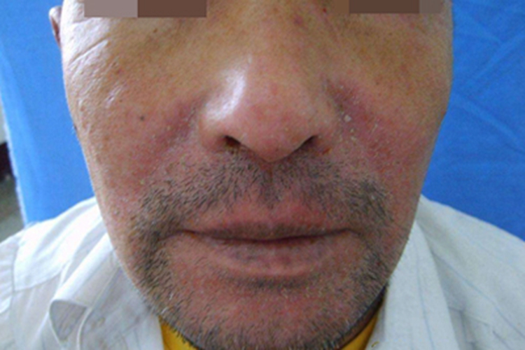 季节性接触性皮炎口周红斑图