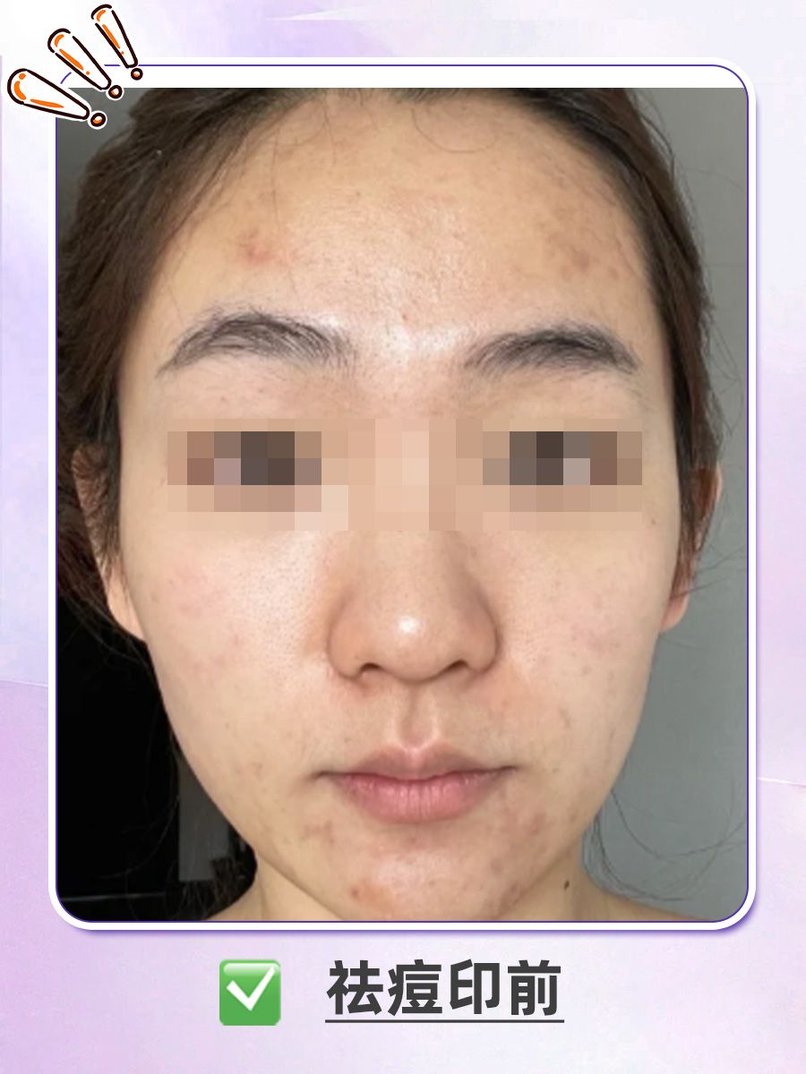 战痘女孩看过来：祛除痘印前后对比图片~