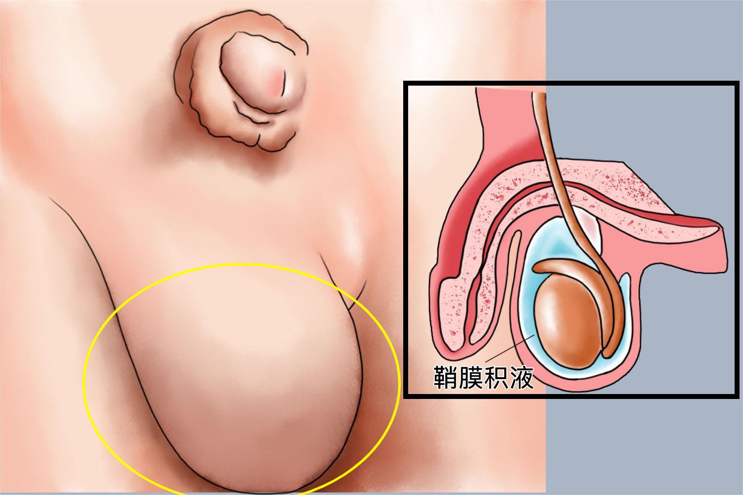 睾丸鞘膜积液阴囊症状手绘图