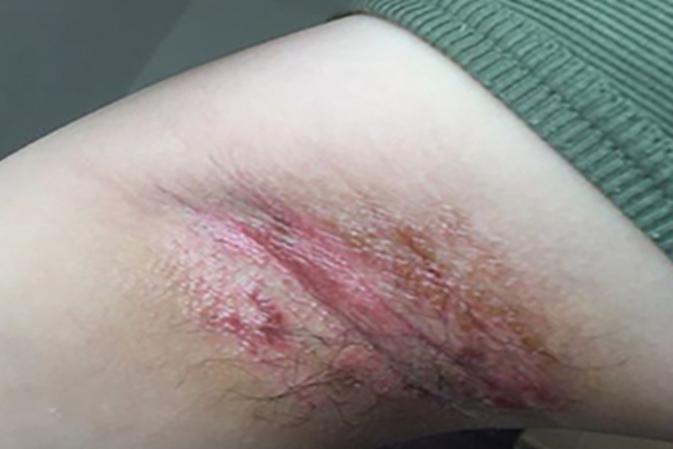急性湿疹腋窝小红疙瘩图