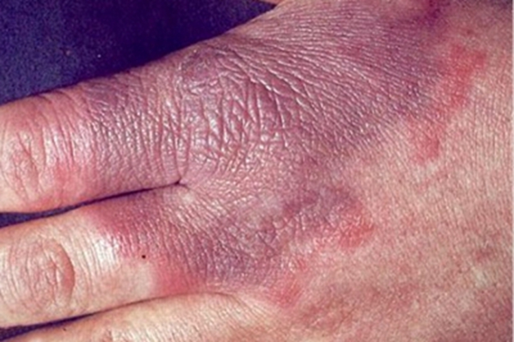 局限型类丹毒皮肤发紫图 局限型类丹毒皮肤发紫图