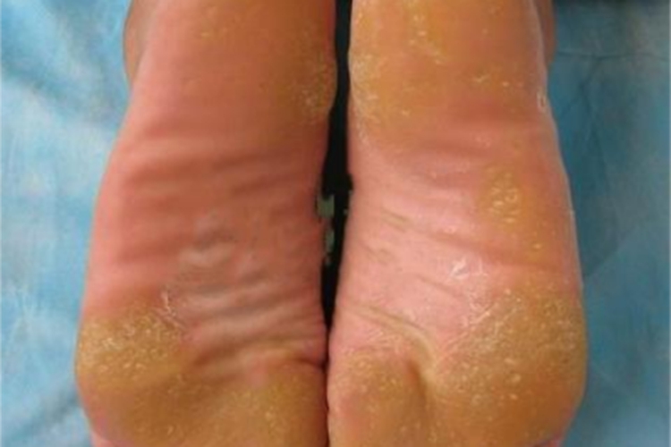点状掌跖角皮症脚底皮肤增厚图