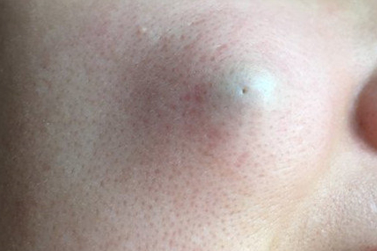 面处皮脂腺囊肿图