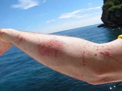 海蜇蜇伤的症状和图片 