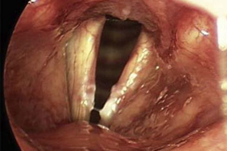 儿童慢性喉炎喉镜图