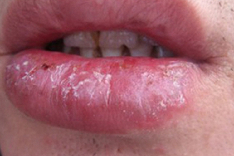 慢性光线性唇炎症状图