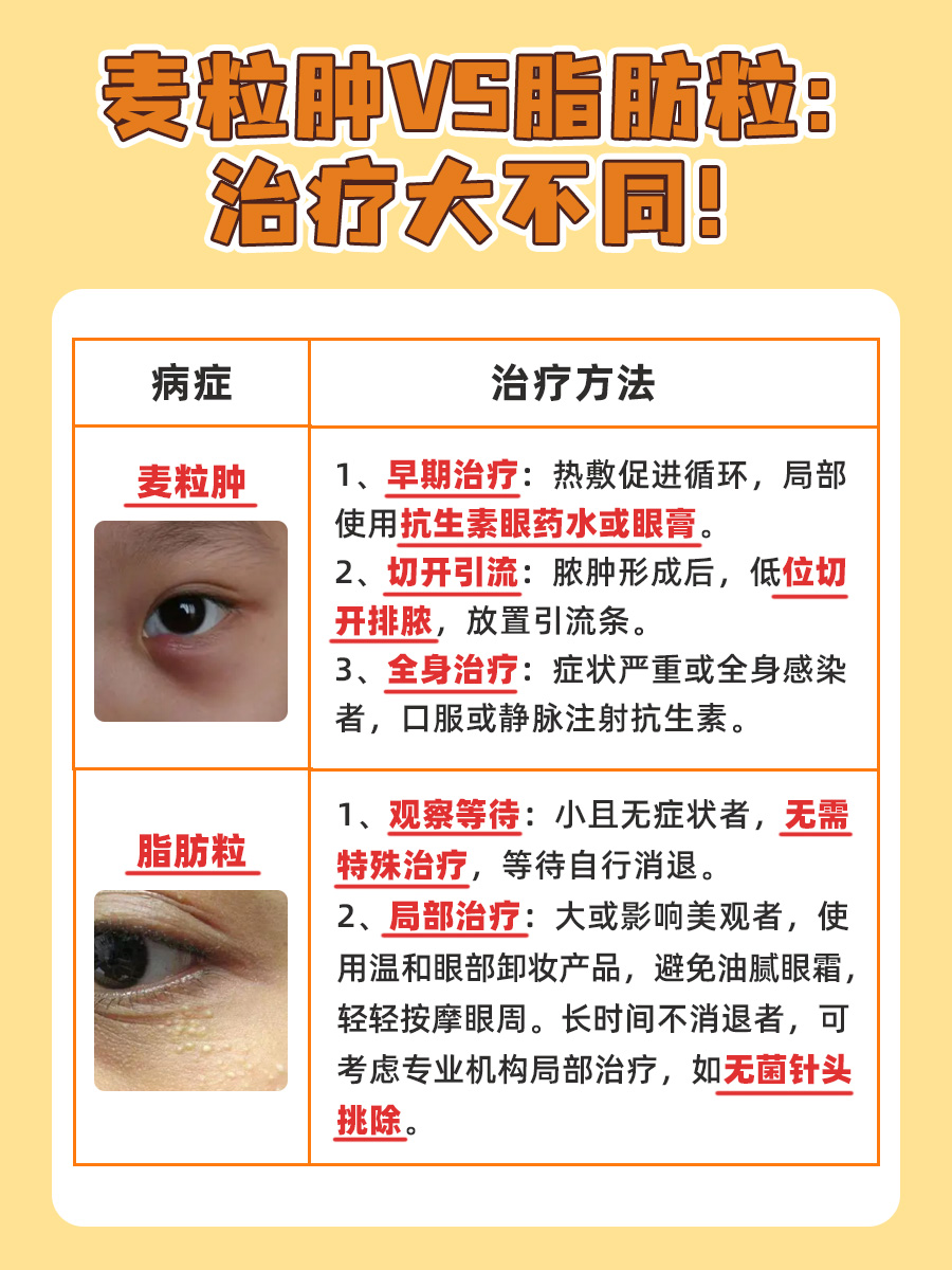 误区揭秘:麦粒肿并非脂肪粒!一文教你分清!