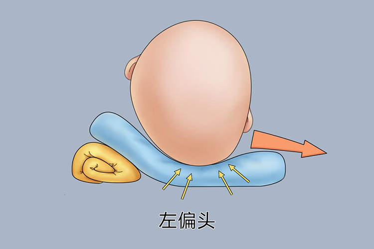 左偏头矫正示意图