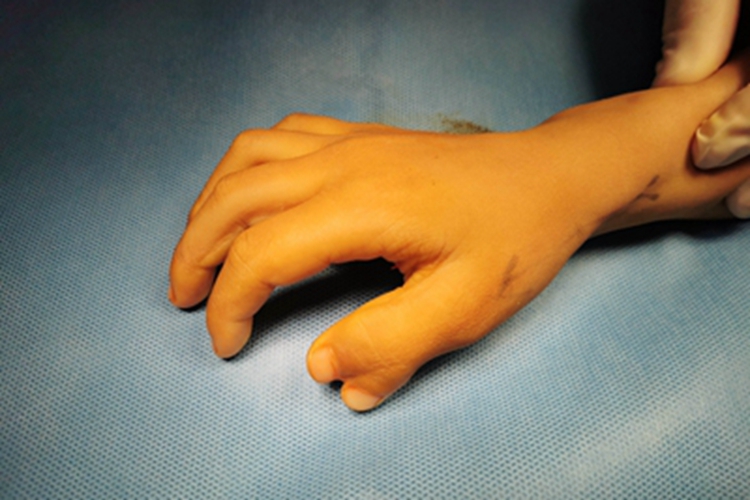 并指畸形两个大拇指粘在一起图 并指畸形两个大拇指粘在一起图