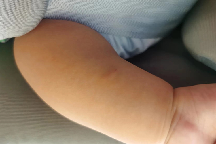 儿童PPD试验正常图 儿童PPD试验正常图