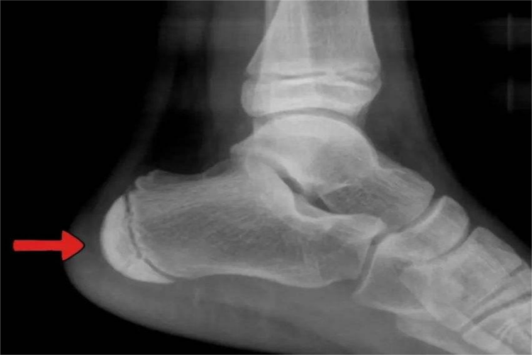 儿童正常跟骨骨骺X线图