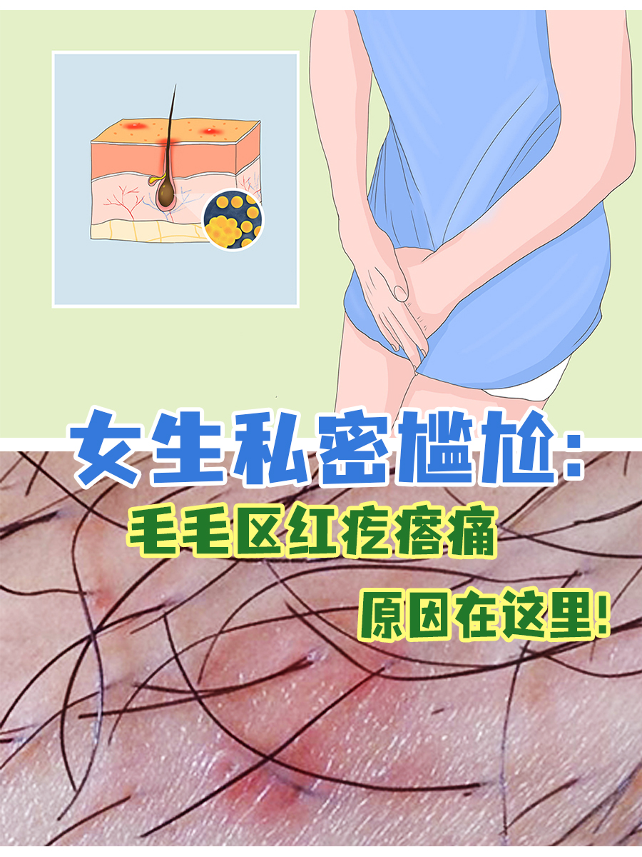 女生私密尴尬：毛毛区红疙瘩痛，原因在这里！