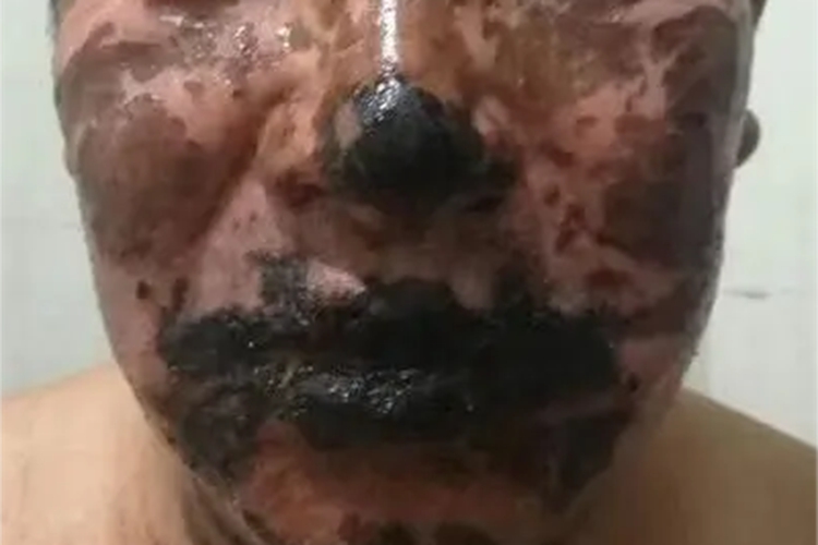 重型多形红斑型药疹嘴唇症状图