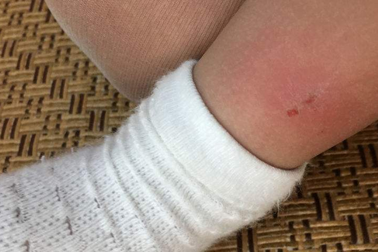 蜈蚣咬的伤口图