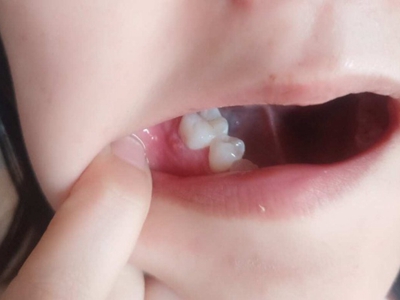 急性浆液性根尖周炎牙龈肿胀长小水疱图