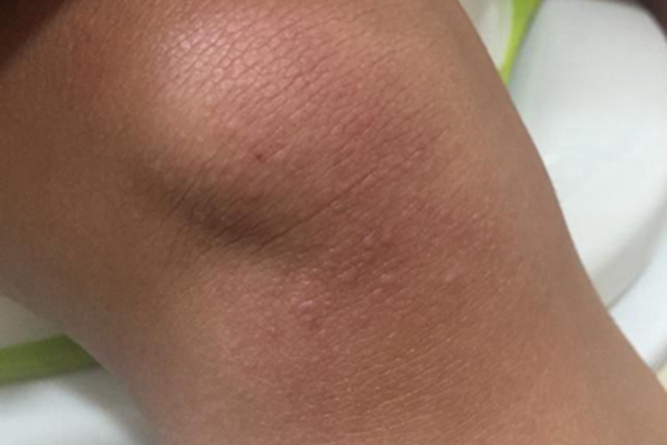 幼年型皮肌炎膝盖症状图