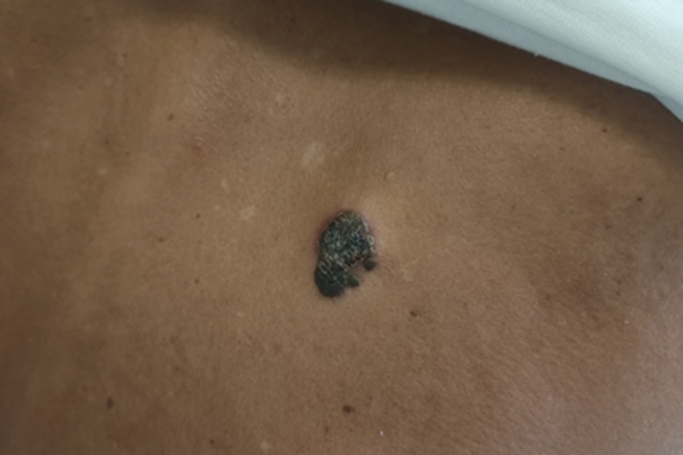 肢端雀斑痣样黑素瘤背部症状图