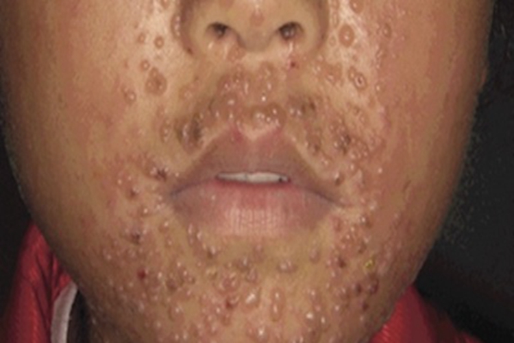 天花水疱图 天花水疱图