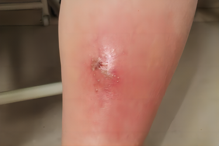 腿上细菌感染红肿图片