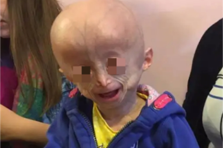 儿童早老症症状图 儿童早老症症状图