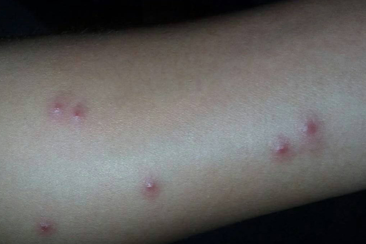 毒虫叮咬后丘疹图