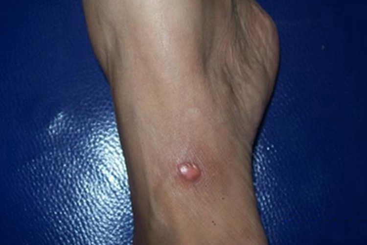 平滑肌瘤症状图