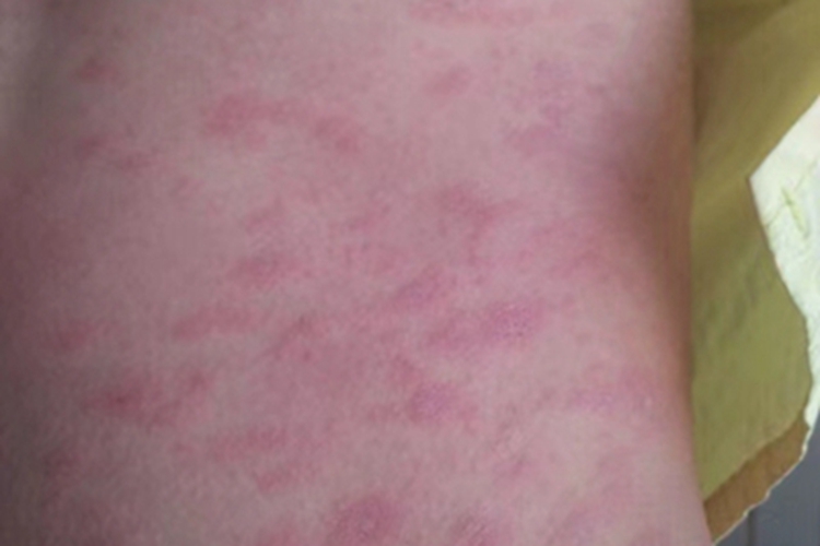 玫瑰糠疹腰部症状图