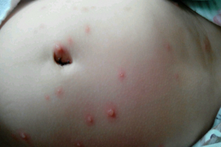 水痘腹部红疙瘩图