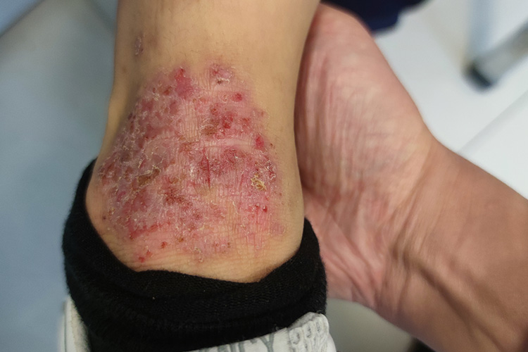 儿童湿疹型皮损图