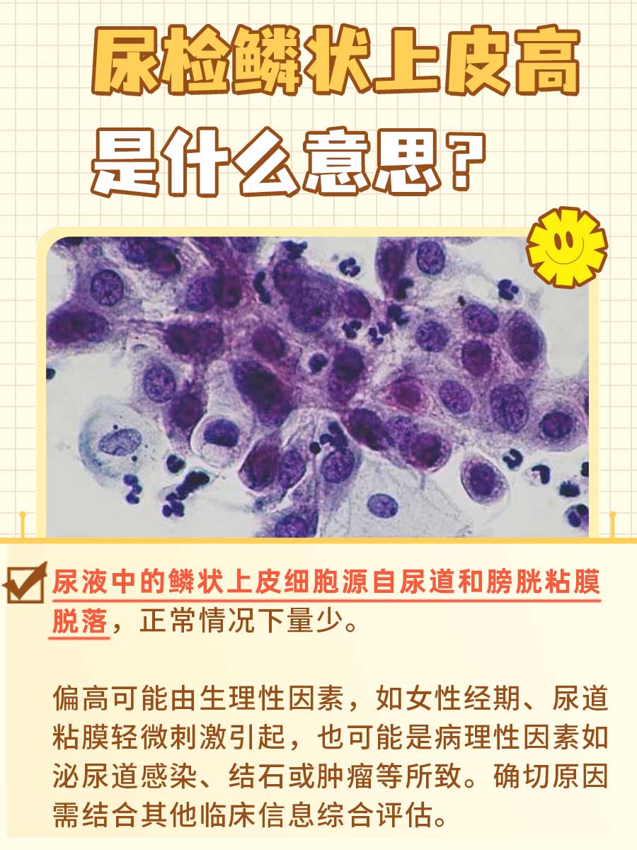 尿检鳞状上皮高是什么意思?你知道吗