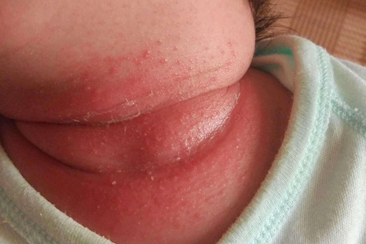 新生儿脖子湿疹图 新生儿脖子湿疹图