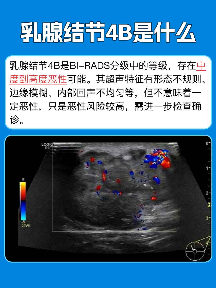 乳腺结节4B是什么，带你了解