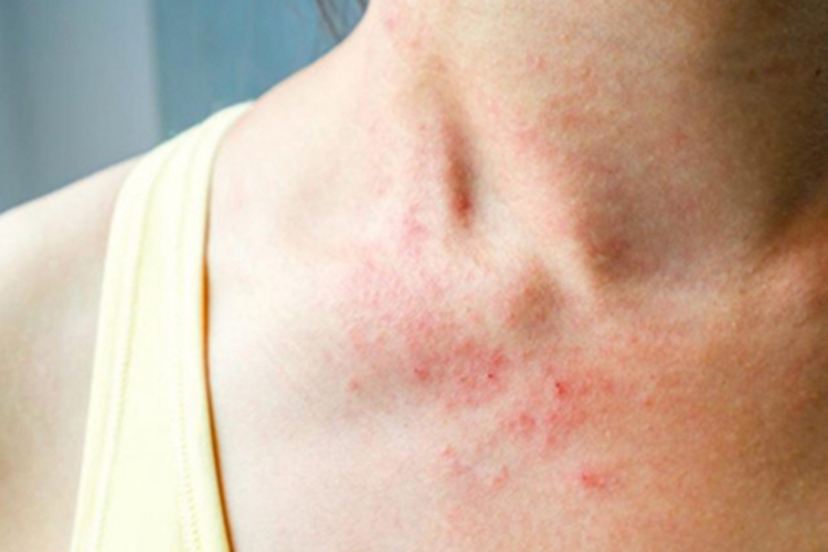 亚急性接触性皮炎胸部红点图 亚急性接触性皮炎胸部红点图