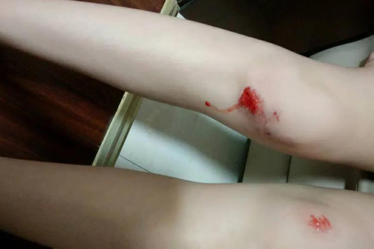 腿摔伤浅表出血图 腿摔伤浅表出血图