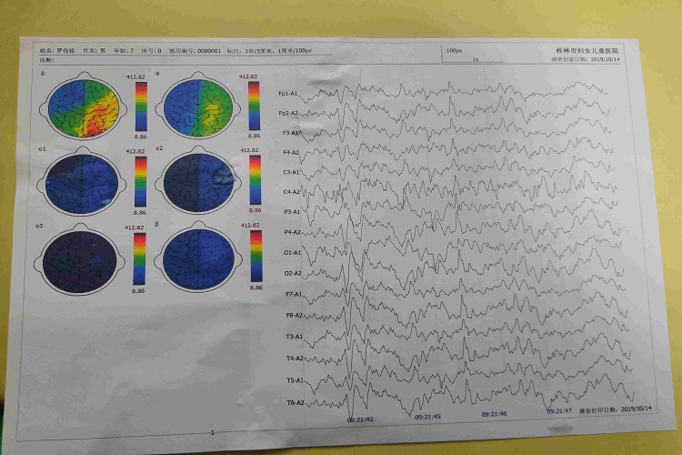 弥漫性轻度异常脑电地形图 弥漫性轻度异常脑电地形图