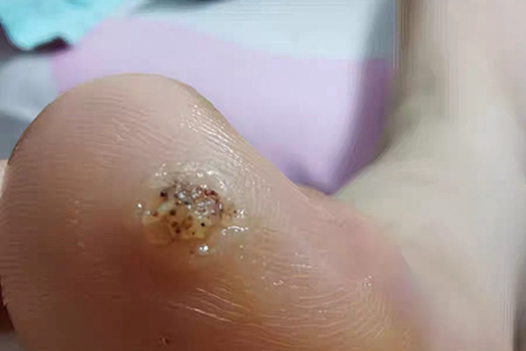寻常疣脚部症状图