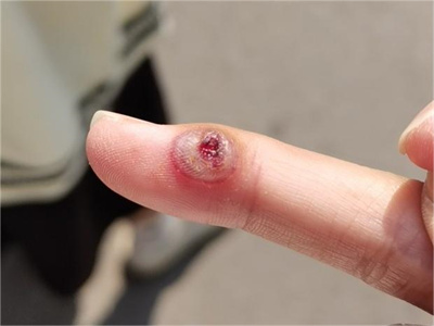 化脓性肉芽肿手指上一个圆形水疱图