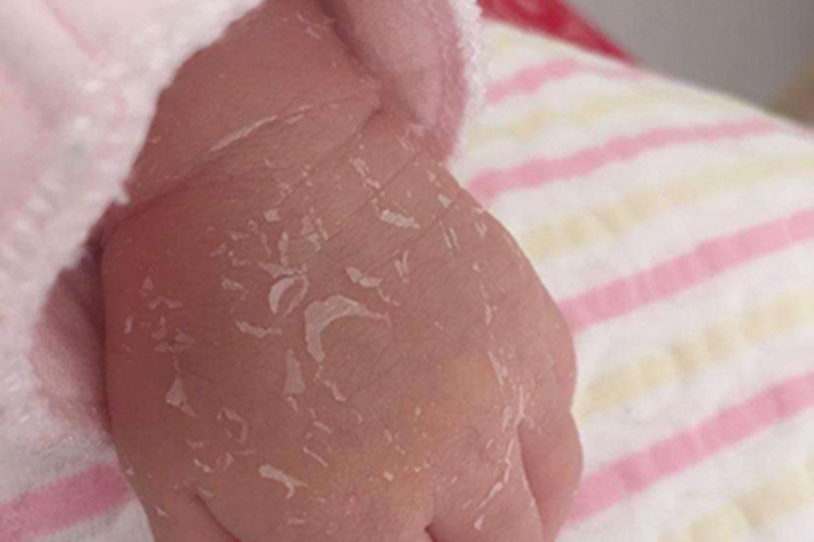 维生素A过多症手背脱皮图