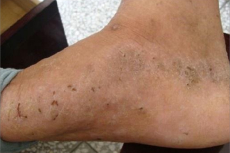 砷角化病脚部皮肤增厚图