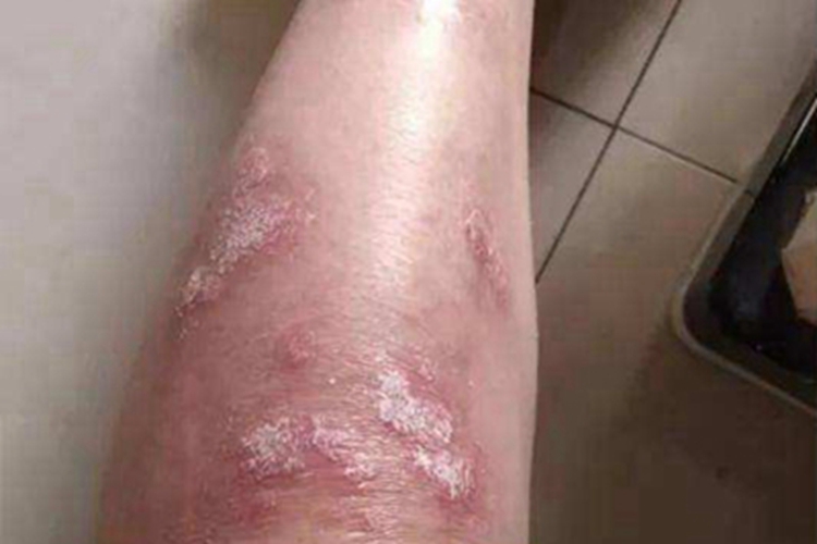 松皮癣小腿皮肤粗糙图 松皮癣小腿皮肤粗糙图