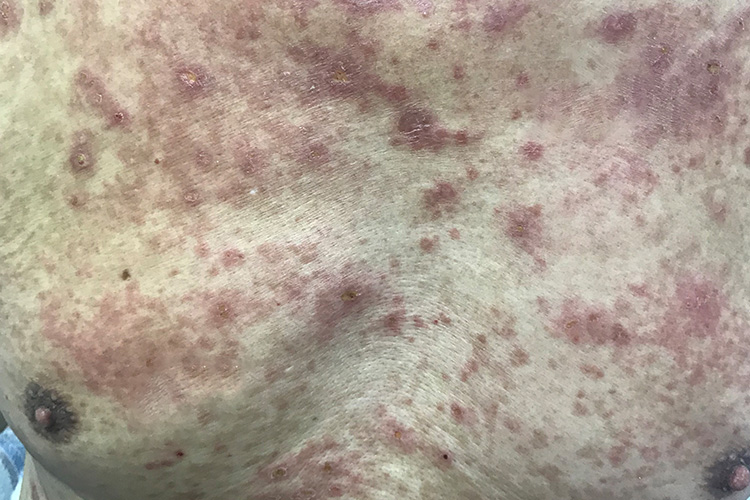 亚急性湿疹图 亚急性湿疹图