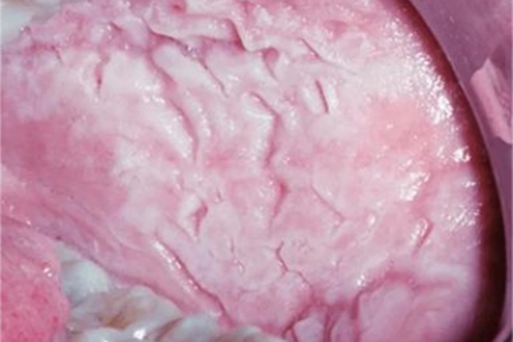 均质型口腔黏膜白斑斑块型白斑图